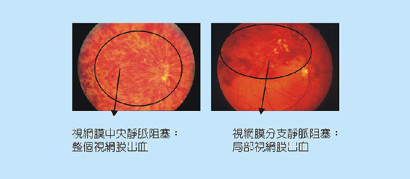 Read more about the article 眼睛也會中風？什麼是視網膜中央靜脈阻塞？